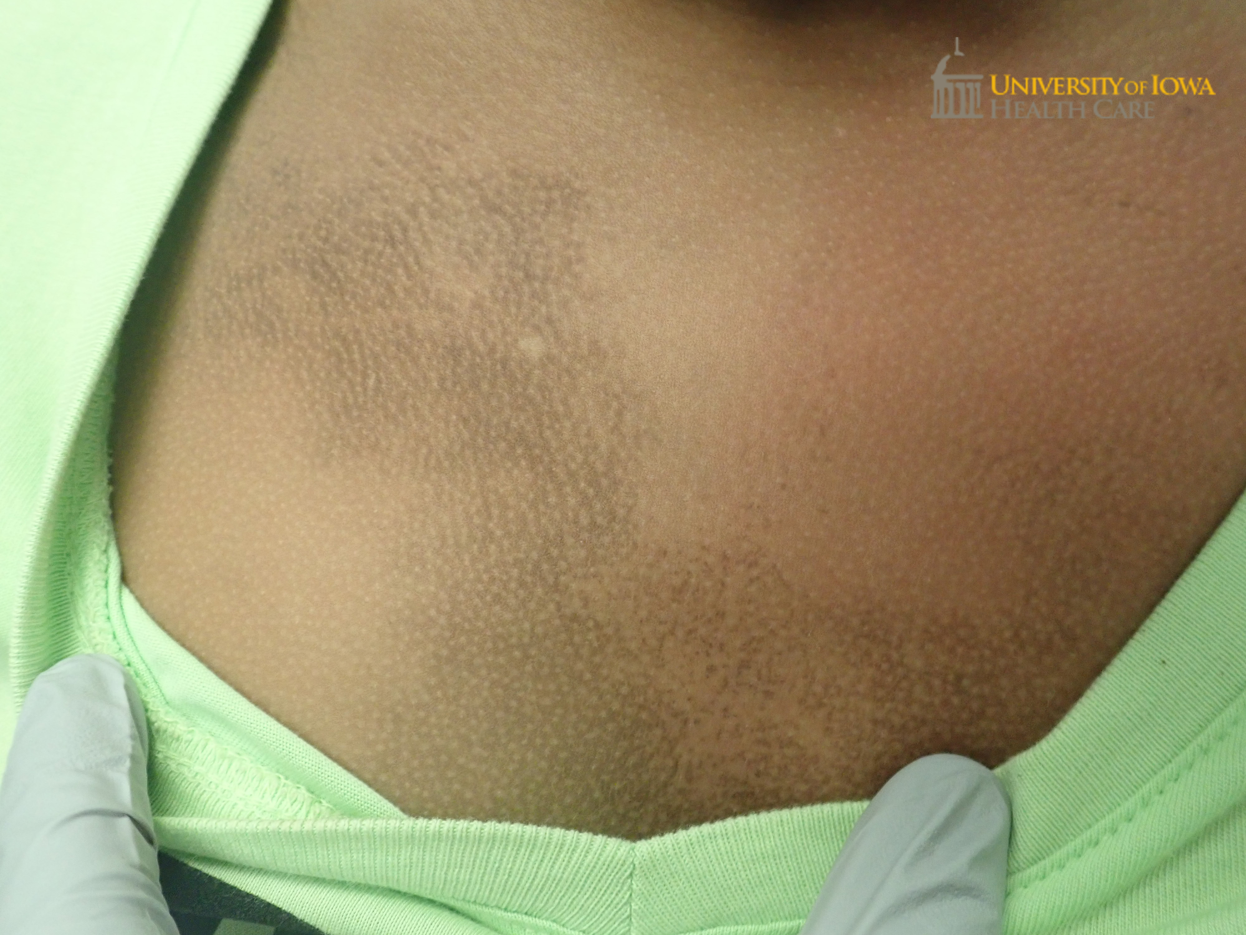 Brown patch with follicular sparing on the chest. (click images for higher resolution).